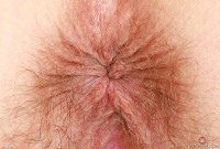 ATK hairy  in mature and hairy