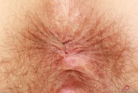 ATK hairy  in mature and hairy