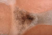 ATK hairy  in mature and hairy