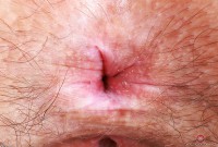 ATK hairy  in young and hairy