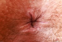 ATK hairy  in young and hairy