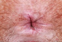 ATK hairy  in young and hairy