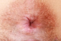 ATK hairy  in young and hairy