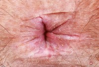 ATK hairy  in young and hairy