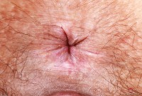 ATK hairy  in young and hairy