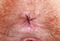 ATK hairy  in young and hairy