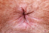 ATK hairy  in young and hairy