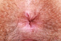 ATK hairy  in young and hairy