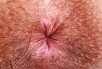 ATK hairy  in young and hairy