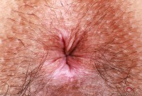 ATK hairy  in young and hairy