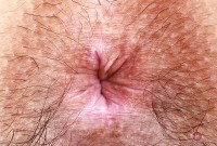 ATK hairy  in young and hairy