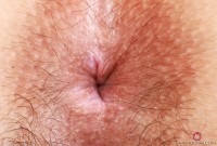 ATK hairy  in young and hairy