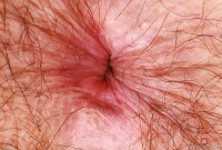 ATK hairy  in young and hairy