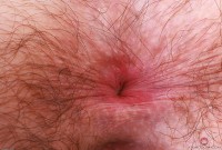 ATK hairy  in young and hairy