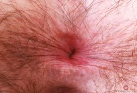 ATK hairy  in young and hairy