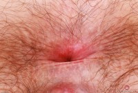 ATK hairy  in young and hairy