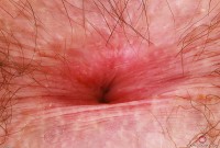 ATK hairy  in young and hairy