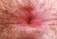 ATK hairy  in young and hairy