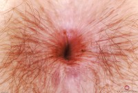 ATK hairy  in young and hairy