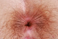 ATK hairy  in young and hairy