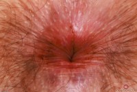 ATK hairy  in young and hairy