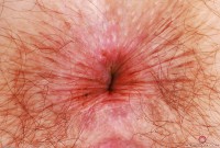 ATK hairy  in young and hairy