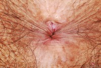 ATK hairy  in young and hairy