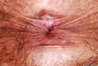 ATK hairy  in young and hairy