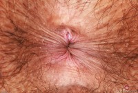 ATK hairy  in young and hairy