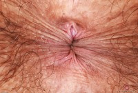 ATK hairy  in young and hairy