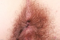 ATK hairy  in young and hairy