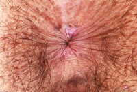 ATK hairy  in young and hairy