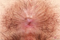 ATK hairy  in young and hairy