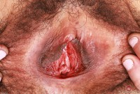 ATK hairy  in young and hairy