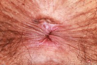 ATK hairy  in young and hairy