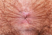 ATK hairy  in young and hairy