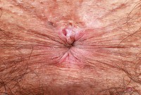 ATK hairy  in young and hairy