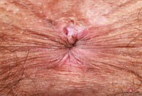 ATK hairy  in young and hairy