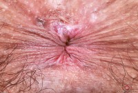 ATK hairy  in young and hairy