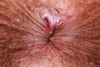 ATK hairy  in young and hairy